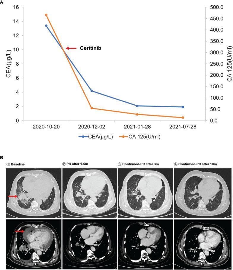 This composite educational graphic illustrates the longitudinal monitoring of a patient with ALK-positive non-small cell lung cancer (NSCLC) undergoing targeted therapy with ceritinib. Panel A is a line graph tracking serum tumor markers CEA (μg/L) and CA 125 (U/ml) over a nine-month period. It shows a rapid quantitative decline in both markers immediately following the initiation of ceritinib, which is marked by a red arrow. Panel B presents dynamic diagnostic imaging using axial CT scans at four intervals: Baseline, Partial Response (PR) after 1.5 months, Confirmed PR after 3 months, and Confirmed PR after 10 months. The lung window (top row) displays a right lung mass (red arrow) that significantly reduces in volume and density over time. The mediastinal window (bottom row) demonstrates a circumferential pericardial effusion (red arrow) at baseline that resolves nearly completely throughout the treatment course. This visual case study highlights the correlation between biochemical marker reduction and radiographic tumor regression (RECIST criteria) in oncological management.