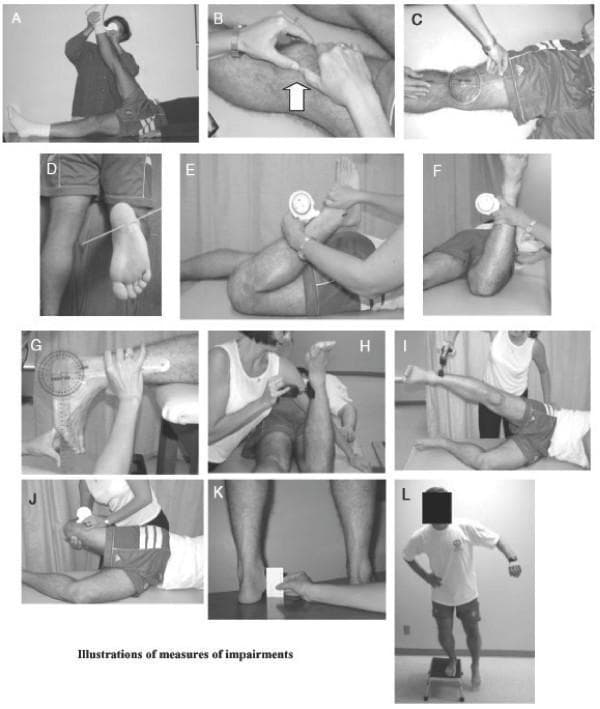 A composite of 12 clinical photographs (labeled A through L) demonstrating physical examination maneuvers and orthopedic tests for evaluating Patellofemoral Pain Syndrome (PFPS). (A) Straight leg raise test for hamstring length. (B) Patellar tilt test assessing lateral retinacular tightness. (C) Measurement of the Q-angle using a universal goniometer. (D) Evaluation of tibial torsion via the intermalleolar axis in a prone position. (E) Quadriceps muscle length measurement using a gravity goniometer during passive knee flexion. (F) Craig’s test for femoral anteversion. (G) Assessment of plantar flexor length (ankle dorsiflexion) with a goniometer. (H) Isometric hip external rotation strength testing. (I) Hip abduction strength testing in a side-lying position. (J) Ober’s test using a gravity goniometer to measure Iliotibial Band (ITB) complex length. (K) Navicular drop test for foot pronation, utilizing an index card and ruler. (L) Functional assessment via the lateral step-down test, observing movement quality and compensation strategies. The collection illustrates diagnostic pathways for biomechanical and musculoskeletal impairments of the lower extremity.
