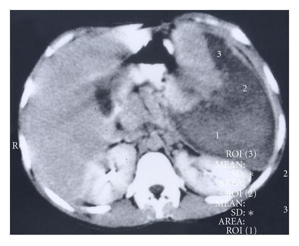 This abdominal axial CT scan demonstrates massive splenomegaly with extensive splenic infarction in a pediatric patient with sickle cell anemia. The spleen is significantly enlarged, occupying a substantial portion of the left upper quadrant and displacing adjacent structures. The splenic parenchyma exhibits a heterogeneous, mottled appearance characterized by large, wedge-shaped and irregular regions of low attenuation (hypodensity), representing infarcted tissue that has lost its blood supply. These infarcted areas are marked with numbered Regions of Interest (ROI 1, 2, and 3) and involve more than 50% of the organ's volume, meeting the criteria for massive splenic infarction. The remaining hyperdense areas represent viable, enhancing splenic tissue. Visible surrounding landmarks include the liver on the right, the kidneys posteriorly, and the vertebral column. The image illustrates a critical complication of sickle cell disease where vaso-occlusive crises lead to major organ ischemia rather than the typical progressive atrophy and autosplenectomy.