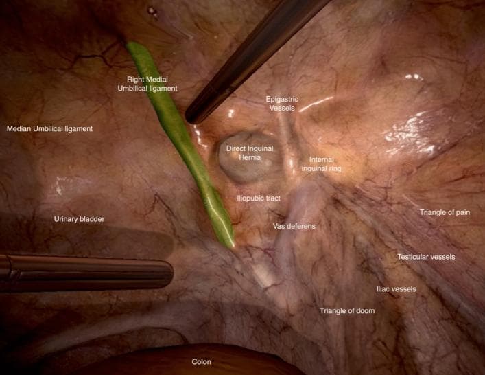 This didactic animation frame depicts the laparoscopic anatomy of the posterior abdominal wall and inguinal region during a Transabdominal Preperitoneal (TAPP) hernia repair simulation. The view shows a right-sided inguinal perspective with several labeled anatomical landmarks and surgical zones. Central to the image is a direct inguinal hernia defect, located medial to the epigastric vessels and internal inguinal ring. The median umbilical ligament is visible on the far left, with the urinary bladder adjacent. A surgical instrument is shown retracting the right medial umbilical ligament (highlighted in green). Further lateral, the iliopubic tract, vas deferens, and testicular vessels are identified. Crucially for surgical safety, the 'Triangle of Doom' (containing the external iliac vessels) is demarcated inferior to the vas deferens, while the 'Triangle of Pain' (containing sensory nerves) is identified superior to the testicular vessels. This image serves as an educational tool for identifying the 'Myopectineal Orifice of Fruchaud' and avoiding vascular or nerve injury during laparoscopic hernia surgery.