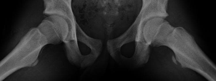 This diagnostic image is a frog-leg lateral (Lauenstein view) X-ray radiograph of the pediatric pelvis and bilateral hip joints. The pelvic ring, including the ilium, ischium, and pubis, is visible with clear visualization of the acetabula. The proximal femurs are abducted and externally rotated. The primary pathology is a displaced avulsion fracture of the left lesser trochanter. This is characterized by a cortical bone fragment detached from the medial aspect of the left proximal femur and displaced inferiorly. The irregular bony contour at the donor site on the left femoral shaft is evident, while the right lesser trochanter remains intact and anatomically normal. The femoral heads appear well-seated within the hip joints with preserved joint spaces. This finding is typical of an adolescent traction injury at the iliopsoas muscle insertion point. The educational focus is on identifying apophyseal avulsion fractures in the pediatric population, specifically involving the lesser trochanter in the setting of athletic injury.