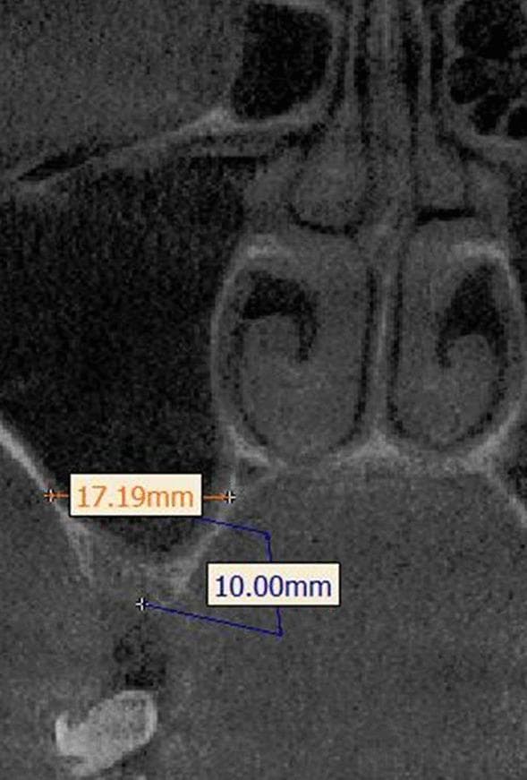 This diagnostic image is a coronal cross-section from a Cone Beam Computed Tomography (CBCT) scan, focusing on the maxillary sinus and midface anatomy. The image demonstrates a standardized methodology for measuring sinus width for implantology or oral surgery planning. An orange horizontal linear measurement of 17.19 mm indicates the sinus width, spanning from the buccal wall to the palatal wall. This measurement is positioned at a specific vertical reference height of 10.00 mm, marked by a blue vertical line originating from the alveolar crest. Key anatomical landmarks visible include the nasal cavity, inferior nasal turbinates, the floor of the maxillary sinus, and the underlying alveolar process. The image serves as a clinical guide for evaluating pneumatization and available bone volume in the posterior maxilla, highlighting the use of fixed reference points (10 mm above the crest) to ensure reproducible radiographic measurements in preoperative assessments.