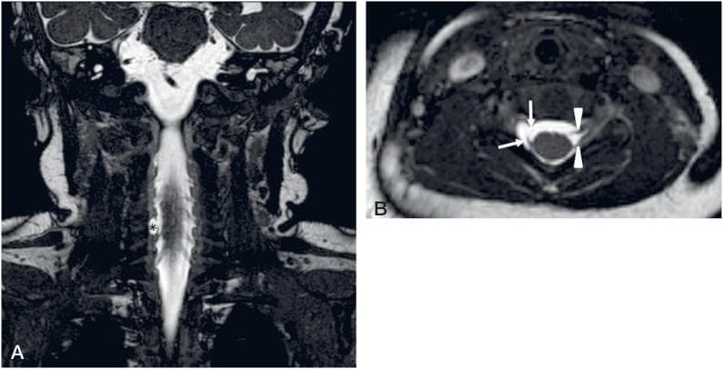 This diagnostic image consists of coronal (A) and axial (B) high-resolution Balanced Fast Field Echo (BFFE) MRI views of the cervical spine in a pediatric patient. The images demonstrate a right-sided brachial plexus birth injury involving a C6 root avulsion. In the coronal view (A), the spinal cord is surrounded by bright cerebrospinal fluid, with a distinctive hyperintense fluid collection (asterisk) on the right side indicating a traumatic pseudomeningocele (PMC). The axial view (B) provides a detailed comparison between the normal left side and the injured right side. On the left, the ventral and dorsal nerve roots are clearly visible as intact hypointense linear structures (arrowheads) emerging from the spinal cord. On the right, the ventral root is completely avulsed from the cord (upper arrow), and only a short remnant stump of the dorsal root is visible (lower arrow) within the CSF-filled pseudomeningocele. This imaging is characteristic of preganglionic nerve root injury in the context of neonatal brachial plexus palsy.