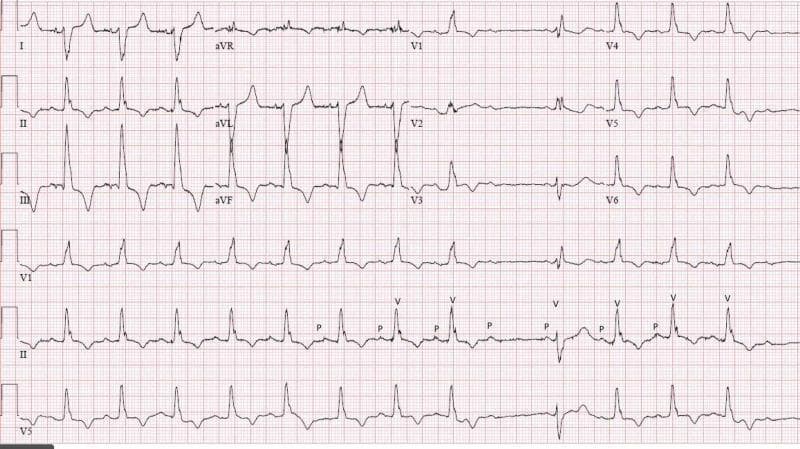A standard 12-lead electrocardiogram (ECG) with rhythm strips (II, V1, V5) demonstrating complex cardiac conduction system disease. Key findings include a widened QRS complex (>120 ms) with an rSR' pattern in lead V1 and slurred S-waves in leads V5 and V6, diagnostic of a Right Bundle Branch Block (RBBB). The limb leads show a right axis deviation (negative QRS in lead I, positive in II and III), which, in combination with RBBB, is consistent with a bifascicular block (specifically RBBB and Left Posterior Fascicular Block). The rhythm strip in lead II is annotated with 'P' and 'V' to highlight atrioventricular dissociation features. It clearly demonstrates Second-degree AV block Mobitz Type II, evidenced by intermittent non-conducted P-waves ('dropped QRS') without progressive PR-interval lengthening. Additionally, the tracing shows a prolonged QTc interval. This ECG illustrates an incomplete trifascicular block, signifying advanced multi-fascicular disease and infra-Hisian conduction failure.