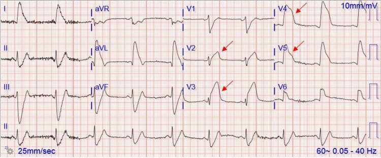 This diagnostic image is a 12-lead electrocardiogram (ECG) demonstrating an ST-elevation myocardial infarction (STEMI). The tracing exhibits significant ST-segment elevation across several leads, most prominently marked with red arrows in the precordial leads V2, V3, V4, and V5. The ST-segments show a convex-upward (coved) morphology, characteristic of acute myocardial injury. Additionally, there is evident ST-segment elevation in the lateral leads (I, aVL) and hyperacute T-waves. Leads II, III, and aVF show reciprocal ST-segment depression. The cardiac rhythm appears to be a sinus bradycardia, with a visible P-wave preceding each QRS complex. The tracing is set at a standard paper speed of 25 mm/sec and a voltage calibration of 10 mm/mV. This ECG is a critical educational tool for identifying the 'tombstone' ST-elevation pattern associated with proximal left anterior descending artery (LAD) or left main coronary artery occlusion, correlating with extensive anterior-lateral wall ischemia.