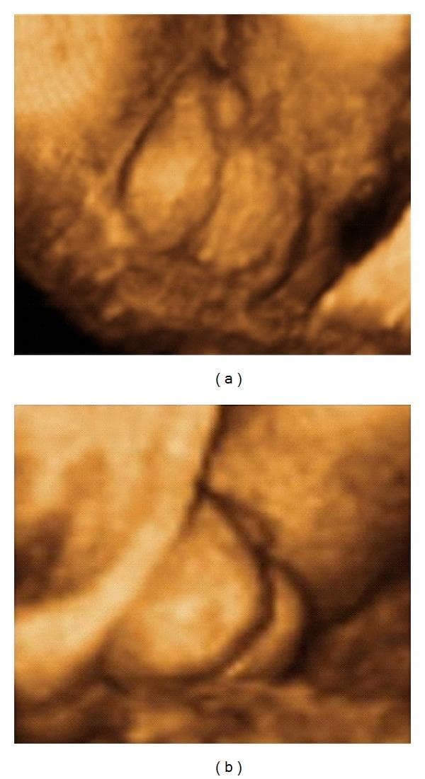 Two-panel 3D prenatal ultrasound in surface rendering mode showing the external genitalia of a male fetus at 33 weeks' gestation, demonstrating features of penoscrotal hypospadias. Image (a) provides a clear view of a bifid scrotum, characterized by a distinct central cleft dividing the scrotal sac into two separate halves. Image (b) shows the spatial relationship between the genitalia, where a short, micropenis-like structure is visible adjacent to the bifid scrotum. In both renderings, the presence of descended testicles within the scrotal halves is suggested by the internal contours of the bifid structure. These diagnostic images are used in maternal-fetal medicine to evaluate congenital urogenital anomalies, facilitating prenatal diagnosis and parental counseling regarding postnatal surgical management.