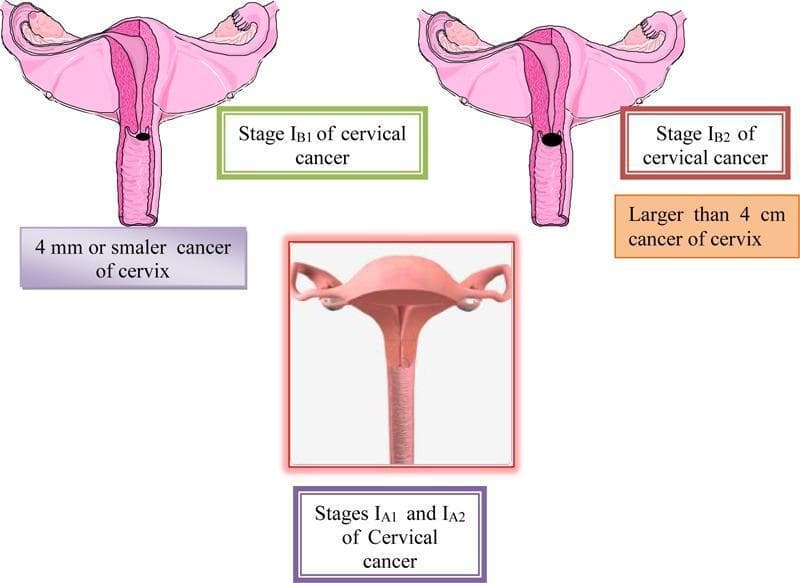 A multi-panel medical illustration and anatomical diagram depicting the FIGO staging of cervical cancer (Stages IA and IB). The central bottom panel displays a 3D-style anatomical diagram representing Stages IA1 and IA2, where the cervix appears macroscopically normal, indicating microinvasive disease that is not visible to the naked eye. The top left panel illustrates Stage IB1, showing a cross-section of the uterus and cervix with a small, localized dark lesion on the cervical canal; it is annotated as a cancer of 4 mm or smaller. The top right panel illustrates Stage IB2, showing a significantly larger, darker, and more prominent exophytic/ulcerative lesion on the cervix, annotated as being larger than 4 cm. All panels show relevant reproductive anatomy including the uterus, fallopian tubes, and ovaries. This educational graphic serves to distinguish clinical stages of cervical carcinoma based on tumor size and macroscopic visibility, relevant for gynecologic oncology and diagnostic pathology training.
