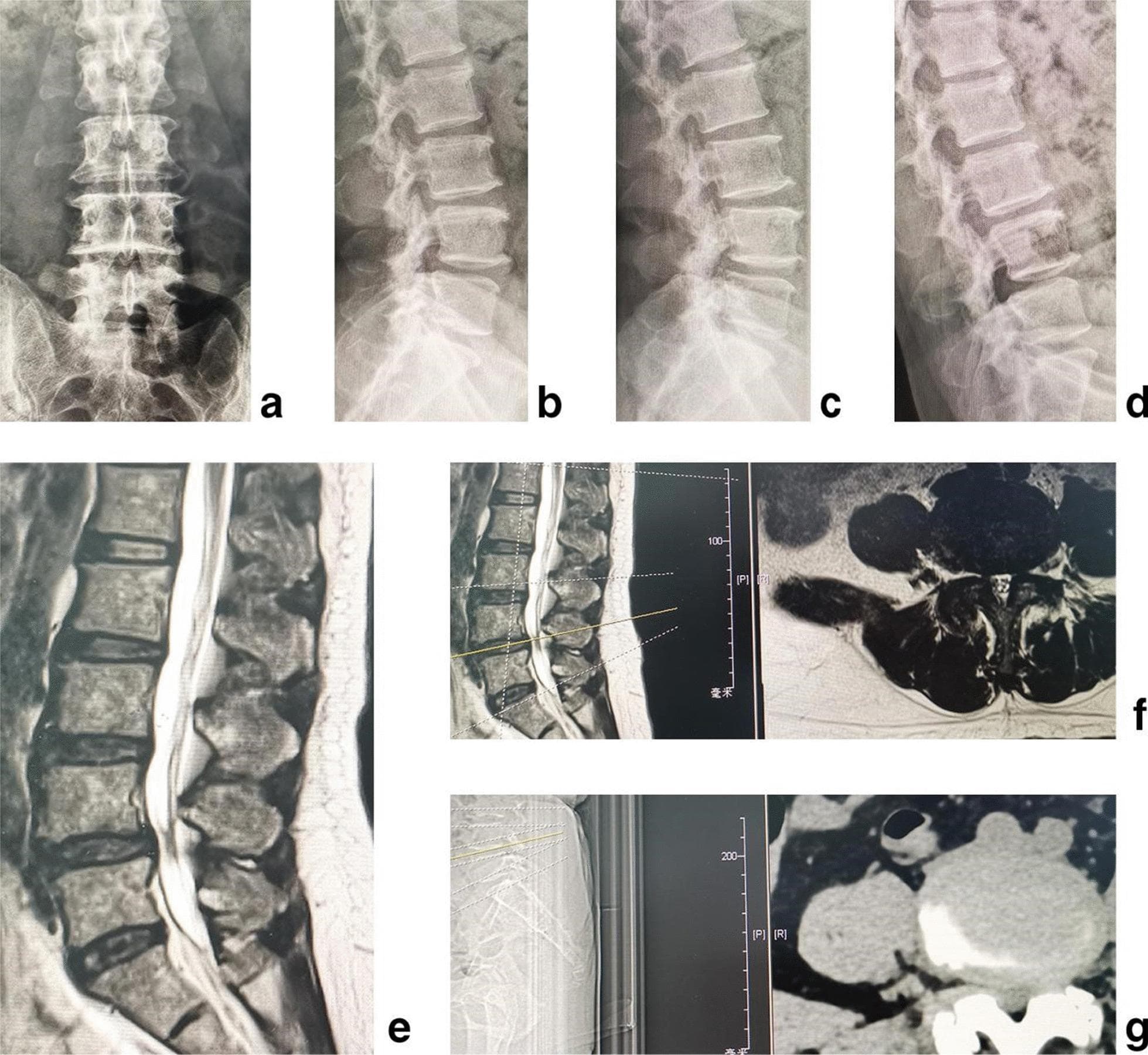 A multi-modal radiological composite demonstrating multilevel lumbar disc degeneration (LDD) and spinal instability in a 58-year-old patient. The image series includes: (a) posteroanterior X-ray showing lumbar alignment; (b) lateral neutral X-ray; (c) hyperextension and (d) hyperflexion lateral X-rays illustrating dynamic instability at the L4/5 level through vertebral translation and angular changes. (e) Sagittal T2-weighted MRI highlights degenerative disc changes across L3/4, L4/5, and L5/S1, characterized by reduced disc height and signal intensity loss (desiccation). (f) Axial MRI provides detailed visualization of central canal stenosis and potential neural foraminal narrowing. (g) Axial CT scan emphasizes bony anatomy, revealing facet joint hypertrophy and osteophyte formation. The collection serves as an educational example of how different imaging modalities contribute to diagnosing complex spinal pathology, specifically highlighting the utility of dynamic X-rays for instability, MRI for soft tissue/disc assessment, and CT for osseous changes in the context of degenerative spine disease.