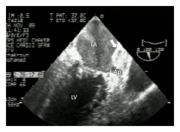 This diagnostic ultrasound image is a transesophageal echocardiography (TEE) view of the heart. Key anatomical structures labeled include the left atrium (LA), left ventricle (LV), and left atrial appendage (L Ap). A prominent abnormality is identified by a white arrow, indicating a large, well-circumscribed, echogenic mass situated within the left atrium and extending into the left atrial appendage. The left atrial cavity also exhibits significant spontaneous echo contrast (SEC), often referred to as 'smoke,' which is a marker of blood stasis. In the clinical context of rheumatic mitral stenosis and atrial fibrillation, these findings are highly suggestive of a large intra-atrial thrombus. The image illustrates critical diagnostic features used in cardiology for assessing embolic risk and evaluating intracardiac masses, such as organized thrombi or myxomas, in patients with valvular heart disease.