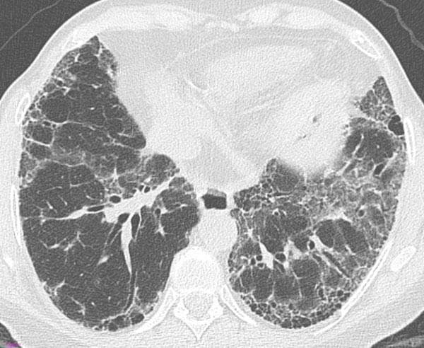 This transverse High-Resolution Computed Tomography (HRCT) axial scan of the thorax demonstrates a 'definite Usual Interstitial Pneumonia (UIP)' pattern, a hallmark of Idiopathic Pulmonary Fibrosis (IPF). The image shows bilateral, predominantly subpleural and basal lung involvement. Key diagnostic features include honeycombing—manifesting as clustered cystic airspaces with thick walls—which is particularly evident in the subpleural region of the left lung. Associated findings include a prominent reticular pattern, traction bronchiectasis (dilatation of bronchi within the fibrotic areas), and mild ground-glass opacities. The distribution is peripheral and basal-predominant, which is characteristic of the ATS/ERS/JRS/ALAT guidelines for diagnosing UIP. This imaging is crucial for medical students and radiologists to distinguish between different patterns of interstitial lung disease (ILD), specifically identifying the architectural distortion and honeycombing required for a definite diagnosis of UIP versus non-specific interstitial pneumonia (NSIP).