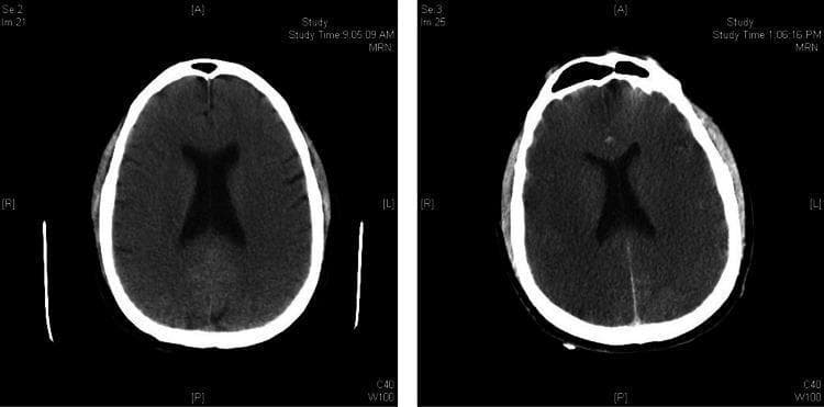 This Comparison Chart features two side-by-side axial non-contrast brain CT scans demonstrating the progression of acute cerebral edema over a short time interval. The initial scan (left) shows preserved sulcal spaces and identifiable gray-white matter differentiation. The follow-up scan (right) reveals significant interval worsening characterized by generalized loss of gray-white matter differentiation and effacement of the cortical sulci, resulting in a 'featureless' appearance of the brain parenchyma. Furthermore, there is a visible decrease in overall tissue density (hypodensity) and compression of the lateral ventricles, consistent with global mass effect from diffuse cerebral edema. These radiological findings are hallmark indicators of severe hypoxic-ischemic brain injury or global metabolic insult. The image serves as a critical diagnostic example for neurology and radiology students to identify radiographic signs of elevated intracranial pressure and evolving brain death patterns.
