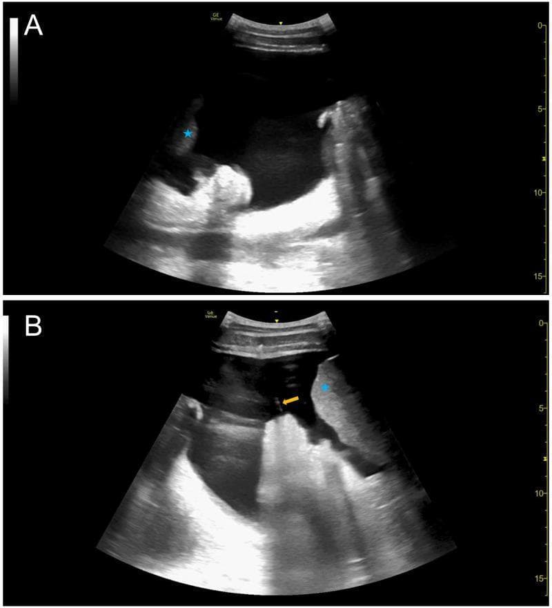This diagnostic imaging composite displays two ultrasound frames (A and B) showing Point-of-Care Ultrasound (POCUS) of the abdomen in a patient with malignant ascites. Image A shows a large, anechoic (black) fluid pocket representing significant ascites in the right lower quadrant. A blue asterisk identifies the liver parenchyma, which appears echogenic relative to the surrounding fluid. Image B captures an intraprocedural view where a paracentesis catheter is visualized as a linear, hyperechoic (bright) structure (yellow arrow). The catheter is positioned within the ascitic fluid, in close proximity to the liver (blue asterisk) and bowel/omentum. These images illustrate the utility of ultrasound for both pre-procedural identification of fluid pockets and real-time guidance during therapeutic paracentesis to avoid injury to adjacent abdominal viscera.