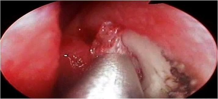 This endoscopic clinical photograph depicts an intraoperative view of the lateral nasal wall during a dacryocystorhinostomy (DCR). The visual field shows a pinkish-red, vascularized nasal mucosa where a curvilinear incision has been made along the maxillary line. A metallic surgical instrument, appearing to be straight Blakesley forceps, is actively lifting a mucosal flap to expose the underlying whitish-yellow bone, identified as the lacrimal bone. Minor bleeding and mucosal edema are visible at the incision margins, typical of surgical tissue disruption. This image serves as an educational representation of the initial steps in endonasal lacrimal surgery, specifically the creation of a mucosal entry point to access the lacrimal sac. The procedural focus is on anatomical landmark identification and the surgical technique for flap elevation in the management of nasolacrimal duct obstruction.