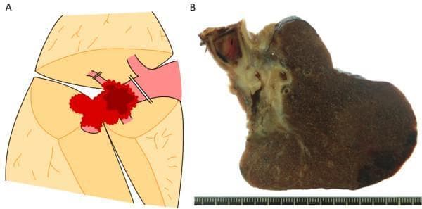 Educational panel illustrating surgical management and pathology of lung adenocarcinoma with vascular invasion. Panel A is a surgical diagram of the right lung hilum. It depicts a red-colored tumor invading the pulmonary trunk and the root of the posterior ascending branch. Surgical management is indicated by double lines representing the ligation and division of the posterior ascending branch and the clamping and suturing of the pulmonary trunk distal to the anterior trunk bifurcation. A brown area within the vessel represents an associated pulmonary artery thrombus. Panel B is a macroscopic clinical photograph of the resected lung specimen. It shows a 40 mm grayish-white tumor mass centered in the hilar region (S6). The specimen demonstrates direct continuous invasion into the pulmonary artery, resulting in complete occlusion of the pulmonary trunk by a massive, dense thrombus. This content illustrates advanced thoracic surgical techniques for vessel preservation (avoiding pneumonectomy) and the gross pathological appearance of T4 stage lung adenocarcinoma with intravascular extension.