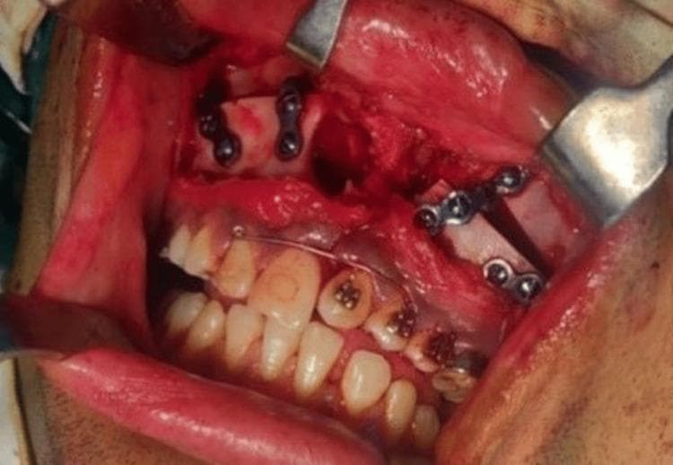 This intra-oral clinical photograph captures an active surgical field during a Le Fort I osteotomy for maxillary advancement. The image shows the maxilla with surgical retraction of the labial and buccal mucosa to expose the bone. Four internal fixation mini-plates, secured with cortical screws, are visible bridging the osteotomy sites to provide rigid stabilization of the repositioned maxillary segments. Specifically, two plates are visible on each side of the mid-face region. Orthodontic hardware, including brackets on the maxillary teeth and a stabilizing archwire, is present to facilitate dental alignment and intraoperative intermaxillary fixation if required. The surgical field demonstrates exposed alveolar bone, soft tissue hemorrhage typical of the procedure, and the use of metal surgical retractors. The image illustrates a critical phase of orthognathic surgery in a patient with a history of cleft palate repair and skeletal Class III malocclusion, focusing on the mechanical stabilization of the advanced maxilla.