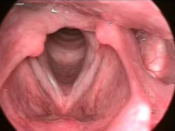 This diagnostic endoscopic photograph displays the human larynx from a superior view, highlighting the anatomy of the glottis and vocal folds. The primary pathology is a sulcus vocalis, visible as a distinct, linear groove or indentation running longitudinally along the mucosal cover of the right vocal fold (anatomical left of the image), parallel to its free edge. This groove disrupts the normally smooth surface of the vocal fold mucosa. In contrast, the contralateral vocal fold appears more uniform. The surrounding structures include the arytenoid cartilages positioned posteriorly, appearing as rounded pinkish masses, and the epiglottis superiorly. The space between the vocal folds reveals the entrance to the subglottis and trachea. The clinical significance of this finding relates to dysphonia, as the sulcus increases mucosal stiffness and prevents complete glottic closure during phonation. This image serves as an educational reference for Otolaryngology (ENT) residents and medical students studying laryngeal disorders and voice pathology.