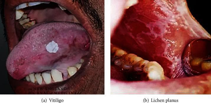 This clinical photograph displays two distinct oral precancerous and mucosal conditions within the oral cavity. Figure (a) illustrates a case of oral leukoplakia (captioned as Vitiligo in some contexts but clinically described here as a precancerous lesion). The lesion is characterized by a solitary, well-demarcated, irregularly shaped white plaque on the dorsal surface of the tongue. The patch is slightly raised with a roughened texture, contrasting with the surrounding erythematous and pinkish mucosa. Figure (b) demonstrates oral lichen planus affecting the buccal mucosa. The visual features include diffuse erythema and inflammation of the soft tissue, overlaid with characteristic Wickham striae—white, lace-like, or web-like reticular patterns. The adjacent gingiva also appears swollen and erythematous. These images serve as educational tools for identifying common oral pathological states that require clinical monitoring for potential malignant transformation into oral cancer.