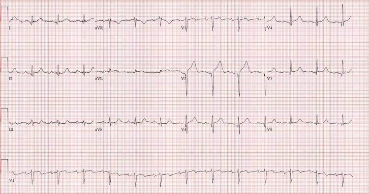 This diagnostic image is a 12-lead electrocardiogram (EKG/ECG) displayed on standard red grid paper, showing a sinus rhythm. The primary clinical findings include significant ST-segment elevation visible in the anterior precordial leads, specifically V2 and V3, as well as lead aVL. In lead V2, the ST elevation is accompanied by hyperacute, tall, peaked T-waves. These findings are highly suggestive of an acute anterior wall myocardial infarction or ischemia. The tracing shows no obvious reciprocal ST-segment depression in the inferior leads (II, III, aVF) within this view. The QRS complexes are narrow and the rhythm appears regular. This visual material is used in emergency medicine and cardiology for identifying acute coronary syndromes and localizing wall motion abnormalities corresponding to coronary artery territories, such as the left anterior descending artery.
