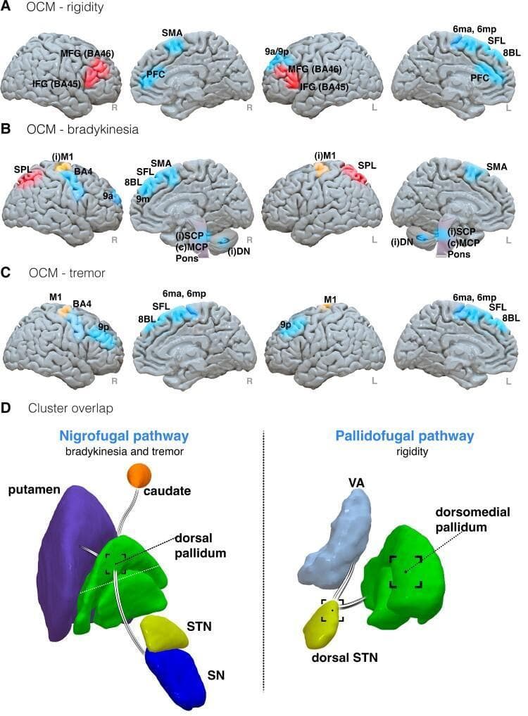 A four-panel medical illustration summarizing diffusion MRI results related to motor symptom improvement in Parkinson’s disease. Panels A, B, and C utilize Outcome Connectivity Mapping (OCM) to show cortical and subcortical regions associated with improvements in rigidity, bradykinesia, and tremor, respectively. Color-coding indicates clinical correlation: blue for improvement, red for worsening, and orange for mixed outcomes. Key identified regions include the supplementary motor area (SMA), prefrontal cortex (PFC), primary motor cortex (M1), and superior frontal language area (SFL). Panel D illustrates 'Cluster overlap' for two major white matter tracts: the Nigrofugal pathway (left), connecting the substantia nigra (SN) and subthalamic nucleus (STN) to the putamen and caudate, associated with bradykinesia and tremor; and the Pallidofugal pathway (right), connecting the dorsomedial pallidum and dorsal STN to the ventral anterior (VA) nucleus of the thalamus, associated with rigidity. Labels identify anatomical structures and Brodmann areas (BA), providing a structural basis for deep brain stimulation (DBS) efficacy.
