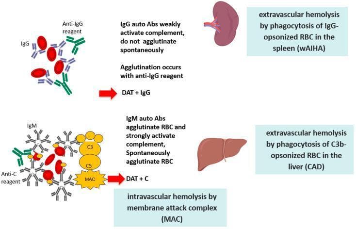 This pathophysiology diagram illustrates the two primary mechanisms of red blood cell (RBC) destruction in Autoimmune Hemolytic Anemia (AIHA). The top section depicts Warm AIHA (wAIHA), characterized by IgG autoantibodies. These monomeric antibodies weakly activate the complement system and do not cause spontaneous RBC agglutination; instead, agglutination occurs only with an anti-IgG reagent, resulting in a positive Direct Antiglobulin Test (DAT + IgG). This pathway leads to extravascular hemolysis via phagocytosis of IgG-opsonized RBCs primarily in the spleen. The bottom section depicts Cold Agglutinin Disease (CAD), mediated by pentameric IgM autoantibodies. These antibodies cause spontaneous RBC agglutination and strongly activate the complement cascade. The diagram shows the binding of C3, C5, and the formation of the Membrane Attack Complex (MAC), leading to intravascular hemolysis. Additionally, it highlights extravascular hemolysis occurring via phagocytosis of C3b-opsonized RBCs in the liver, with a positive Direct Antiglobulin Test for complement (DAT + C). Key anatomical landmarks include the spleen for IgG-mediated clearance and the liver for C3b-mediated clearance.