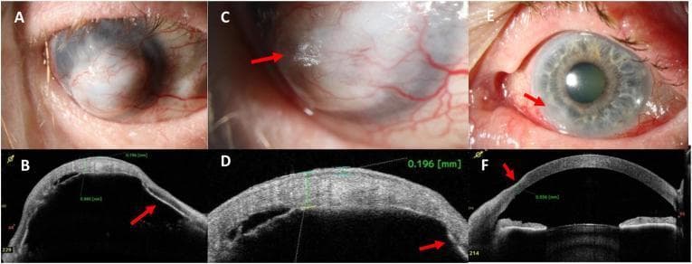 This composite image presents clinical photographs and Anterior Segment Optical Coherence Tomography (AS-OCT) findings in a case of severe keratomalacia associated with Vitamin A deficiency. Panels A-D focus on the right eye (OD). Panel A shows advanced corneal melting (keratomalacia) characterized by a bulging, whitish corneal surface completely overgrown by vascularized conjunctival tissue (conjunctivalization). Panel C highlights keratinization on the corneal surface, resembling Bitot's spots (arrow). Panels B and D provide AS-OCT cross-sections showing massive corneal thickening (940 μm), epithelial thickening (196 μm), and complete iris-to-cornea attachment (athalamia/anterior synechiae, arrow). Panels E and F focus on the left eye (OS). Panel E demonstrates bulbar conjunctival hyperemia and a hazy peripheral lesion at the 7-8 o'clock position (arrow). Panel F (AS-OCT) confirms slight peripheral corneal thinning to 556 μm in that same region (arrow). This series illustrates the range of ophthalmic manifestations of systemic malnutrition, from early peripheral thinning to end-stage keratectasia and corneal scarring.