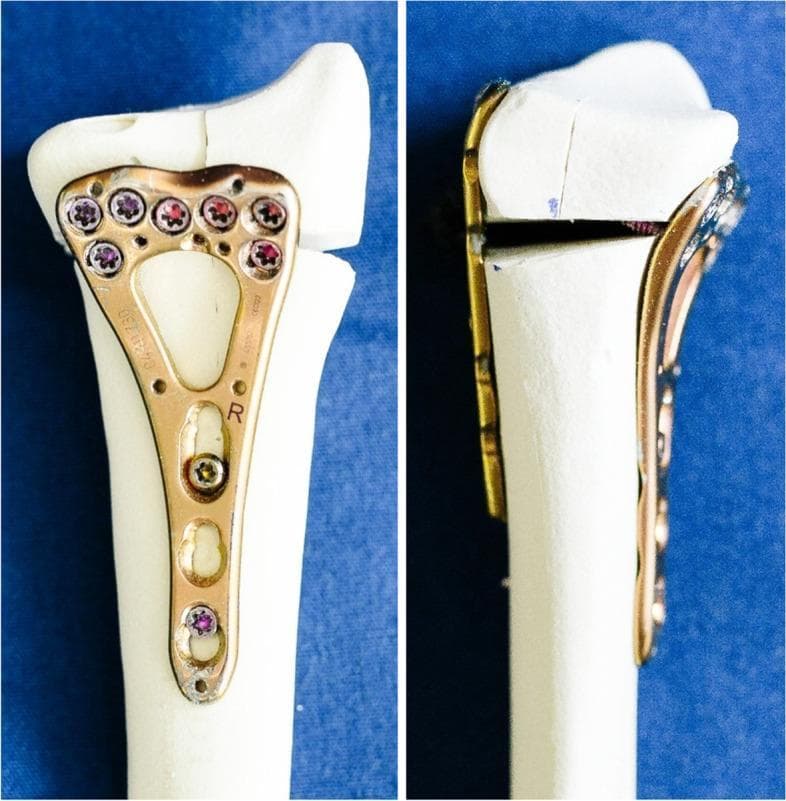 This comparative clinical imaging demonstrates internal fixation techniques for distal radius fractures using synthetic bone specimens. The image is divided into two panels: the left shows a volar locking plate (VLP) construct, and the right shows a double-plating construct. The VLP (left) is a 2.4 mm Variable Angle Locking Compression Plate (LCP) with a two-column design, anatomically contoured to the volar surface of the distal radius. It features multiple locking screws in the head to stabilize articular fragments and shaft screws for cortical fixation. The plate includes 'R' (right) and manufacturer markings. The right panel illustrates a 'sandwich' or double-plating technique, utilizing the same volar plate in conjunction with a supplemental dorsal LCP. This configuration is used to address complex intra-articular fractures with dorsal comminution, particularly involving the lunate facet. The visible osteotomy gap in the specimens simulates a clinical fracture. These constructs highlight orthopedic strategies for achieving rigid stability in distal radius osteosynthesis, emphasizing the difference between standard single-plate volar fixation and dual-plate stabilization for multi-fragmentary fractures.