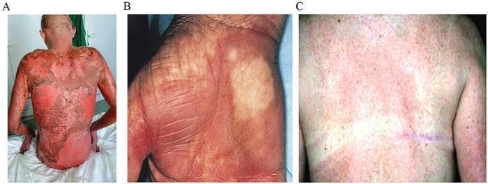 Clinical photograph set illustrating dermatological manifestations of Graft-Versus-Host Disease (GVHD). Figure A displays acute stage IV GVHD on a patient's back, characterized by diffuse, confluent erythema and extensive epidermal sloughing (desquamation) resembling toxic epidermal necrolysis, indicative of severe mucosal and skin involvement following myeloablative conditioning. Figure B shows chronic skin GVHD on a hand, featuring palmar erythema, areas of hypopigmentation, and sclerodermatous changes with accentuated skin markings and fine wrinkling, suggesting loss of elasticity and chronic dermal remodeling. Figure C demonstrates chronic GVHD on the torso with a widespread maculopapular rash, mottled pigmentation, and less severe inflammatory response compared to the acute stage. This comparison serves as an educational tool for distinguishing between the inflammatory, life-threatening presentation of acute GVHD and the fibrotic or pigmentary changes typical of chronic GVHD in hematopoietic stem cell transplant recipients.