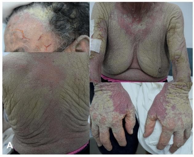A composite clinical photograph showing four panels of a patient with Norwegian (crusted) scabies. The visual findings demonstrate disseminated, greenish-gray, hyperkeratotic plaques and thick crusts extensively involving the scalp, trunk (chest and back), upper extremities, and hands. Key dermatological features include significant skin thickening, a fissured texture, and underlying confluent erythema. The most severe crusting is evident on the dorsum of the hands and fingers, typical of high mite burden areas. The scalp panel shows prominent scaling and crusted lesions extending into the hairline. On the trunk and arms, the lesions present as broad, scaly patches with deep cutaneous folds. This clinical presentation illustrates the classic manifestations of crusted scabies, often associated with immunosuppression or neglected infestation, leading to extreme hyperkeratosis and secondary bacterial infection risk. The educational focus is on the morphology and distribution of specialized scabies infestations in a clinical setting.