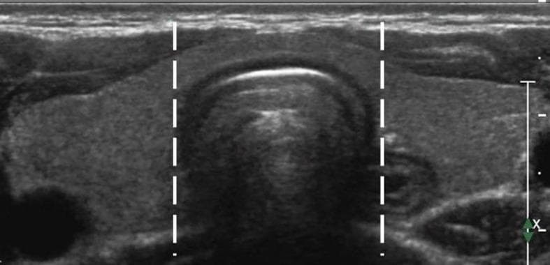This diagnostic image is a transverse greyscale ultrasound of the anterior neck, specifically showing the thyroid gland. The image functions as an anatomical diagram to define the boundaries of the thyroid isthmus. The thyroid parenchyma appears homogeneous and moderately echogenic. Two vertical dashed white lines are superimposed on the image to delineate the lateral side-lines (lateral borders) of the trachea, which lies immediately posterior to the thyroid isthmus. The tissue situated between these two markers is identified as the isthmus, while the thyroid tissue lateral to these lines represents the left and right thyroid lobes. The trachea itself exhibits characteristic sonographic features, including an echogenic anterior border with posterior acoustic shadowing. This visual representation is used for clinical classification, particularly in determining the location of thyroid nodules or Papillary Thyroid Microcarcinomas (PTMC) for procedures like ultrasound-guided Radiofrequency Ablation (RFA).