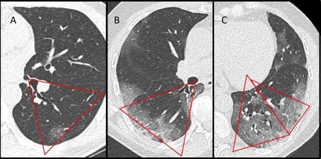 This diagnostic image consists of three axial low-dose computed tomography (LDCT) scans of the lungs, labeled A, B, and C, demonstrating a visual scoring system for COVID-19 pneumonia severity. Red triangles delineate specific bronchopulmonary segments (e.g., segments 6, 9, and 10) to illustrate various degrees of pulmonary involvement. Panel A shows minimal involvement characterized by discrete, focal ground-glass opacities (GGO) occupying less than 10% of the segment. Panel B illustrates intermediate involvement, where hazy GGOs cover approximately 50% of the right lung's 6th segment, resulting in increased lung density while preserving vascular visibility. Panel C demonstrates severe involvement in the left lung base, featuring a combination of extensive GGOs and areas of consolidation (denser opacification) covering over 50% of the highlighted segments. The series serves as an educational tool for calculating the COVID19-LDCT score, emphasizing the transition from localized, subtle interstitial changes to diffuse, heterogeneous parenchymal disease. Key features depicted include peripheral distribution and varying morphology of lung opacities used in clinical radiology to quantify disease progression.