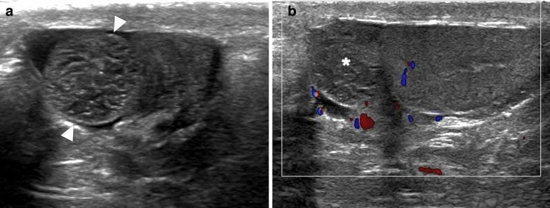 This dual-panel diagnostic ultrasound image illustrates a case of torsion of the appendix testis in a 9-year-old patient. Panel (a) is a grayscale ultrasound showing a well-defined, round, solid-appearing extratesticular lesion (arrowheads) located adjacent to the upper pole of the left testis. The lesion exhibits a mildly heterogeneous echotexture compared to the adjacent testicular parenchyma. Panel (b) shows a color flow Doppler ultrasound of the same region. The lesion (asterisk) demonstrates a complete absence of internal vascularity (avascularity), which is a key diagnostic feature of torsion. In contrast, normal blood flow signals (red and blue) are visible in the surrounding scrotal tissues and the adjacent testis. Additional secondary signs visible include minimal reactive hydrocele and mild scrotal wall thickening. This imaging presentation is characteristic of a torsed testicular appendage, a common cause of acute scrotum in the pediatric population, requiring differentiation from testicular torsion or epididymo-orchitis.