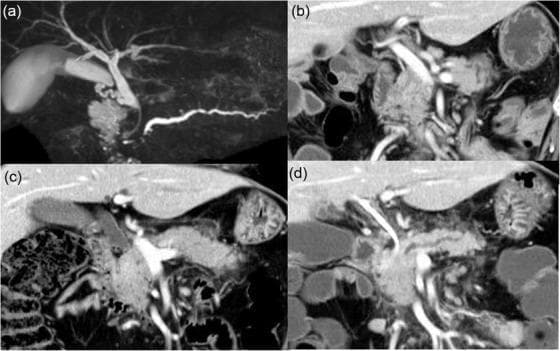 This composite figure displays diagnostic imaging of the hepatobiliary and pancreatic systems. Image (a) is a Magnetic Resonance Cholangiopancreatography (MRCP) demonstrating significant stenosis of the distal common bile duct and the distal main pancreatic duct, resulting in proximal ductal dilation (double-duct sign). A linear radiopaque plastic stent is visible within the common bile duct. Images (b), (c), and (d) are coronal CT scans showing the temporal progression of pancreatic pathology. Image (b) shows the baseline appearance. Image (c), acquired 11 months later, reveals diffuse swelling (hypertrophy) of the entire pancreatic parenchyma. Image (d) illustrates subsequent disease evolution, characterized by swelling localized to the pancreatic head, while the body and tail exhibit atrophic changes. Significant peripancreatic soft tissue infiltration is also noted in (d). This series is clinically relevant for evaluating secondary pancreatic involvement and biliary obstruction, typically seen in metastatic disease or progressive pancreatic conditions.