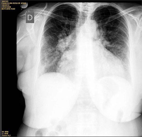 This diagnostic image is a posterior-anterior (PA) chest radiograph demonstrating significant cardiopulmonary pathology. The most prominent finding is marked cardiomegaly, with the cardiac silhouette significantly enlarged, resulting in an increased cardiothoracic ratio. There is evidence of pulmonary venous congestion, characterized by prominent hilar vasculature and diffuse, bilateral reticular opacities most concentrated in the perihilar and central lung fields. The lungs show vascular engorgement, consistent with congestive heart failure. The mediastinal contour appears widened, and the left heart border is shifted laterally due to ventricular enlargement. The diaphragmatic domes are partially obscured by the enlarged cardiac mass and overlying breast tissue shadows. This radiograph is an educational example of how chronic cardiac dysfunction manifests visually as volume overload and interstitial pulmonary edema in a clinical setting.