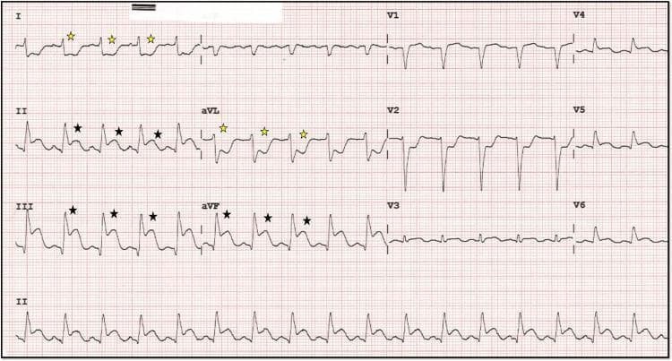 A 12-lead electrocardiogram (ECG) demonstrating diagnostic findings of an acute inferior wall myocardial infarction (ST-elevation myocardial infarction, or STEMI). The primary findings include significant ST-segment elevation in the inferior leads (II, III, and aVF), marked with black stars. Concurrently, there is evidence of reciprocal ST-segment depression in the high lateral leads (I and aVL), indicated by yellow stars. The precordial leads (V1-V3) also exhibit prominent ST-segment depression, which can suggest posterior wall involvement or reciprocal changes from the inferior injury. The inferior leads show a 'shark fin' morphology, characterized by a fusion of the QRS complex, ST segment, and T wave, typically indicating a large area of transmural ischemia. The rhythm appears to be a junctional or sinus bradycardia/tachycardia depending on the clinical phase, with evident electrical instability. This ECG is a critical educational example for identifying acute coronary syndrome and understanding the relationship between anatomical lead groups and reciprocal changes.