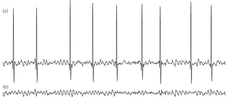This diagnostic image displays a two-panel comparison of electrocardiogram (ECG) waveforms focusing on atrial fibrillation signal processing. Panel (a) illustrates a typical ECG segment exhibiting the characteristic features of atrial fibrillation, including irregularly irregular R-R intervals and the presence of fine fibrillatory (f) waves instead of distinct P waves. The vertical spikes represent the high-amplitude R-peaks of the ventricular QRST complexes. Panel (b) shows the isolated atrial fibrillatory signal after the application of an average QRST complex subtraction algorithm. This isolated 'f-wave' signal is characterized by low-amplitude, high-frequency, and irregular oscillations that reflect disorganized atrial electrical activity. The educational focus is on the signal processing techniques used in cardiology to extract and analyze atrial activity independently from ventricular interference, which is crucial for assessing the complexity of atrial fibrillation and predicting treatment outcomes like electrical cardioversion success.