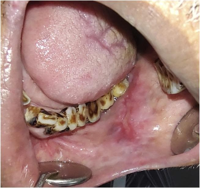 This clinical intraoral photograph demonstrates an erythroplakia patch on the left buccal mucosa. The lesion presents as a well-demarcated, predominantly erythematous (bright red) patch that contrasts sharply with the surrounding paler pink normal oral mucosa. The surface texture appears relatively smooth and velvety, a classic clinical feature of erythroplakia. The primary lesion is located adjacent to the mandibular teeth. Notable secondary findings include significant extrinsic dental staining and calculus buildup on the lower dentition, which may be clinical markers for tobacco or areca nut use—major risk factors for oral potentially malignant disorders (OPMDs). The tongue is visible and appears generally healthy with normal papillation. This image is an educational example used to teach the identification of high-risk premalignant lesions, as erythroplakia carries a significantly higher risk of malignant transformation (MT) compared to leukoplakia, often harboring severe dysplasia or carcinoma in situ upon histological examination.