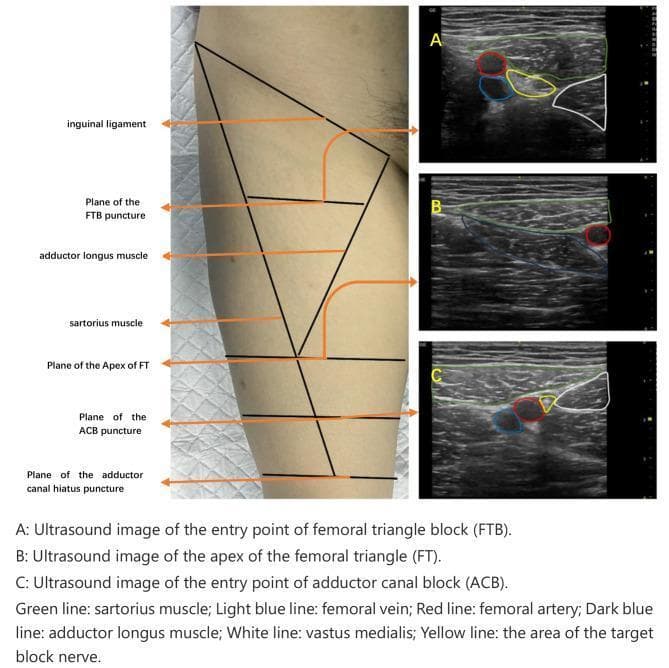 This composite educational graphic details the ultrasound-guided regional anesthesia of the lower limb, specifically comparing the femoral triangle block (FTB) and adductor canal block (ACB). A clinical photograph of a patient's medial thigh demonstrates the surface anatomy and puncture planes relative to the inguinal ligament, sartorius muscle, and adductor longus. Three corresponding transverse ultrasound images (A, B, C) illustrate key cross-sectional anatomy. Image A shows the FTB entry point, identifying the femoral artery (red), femoral vein (light blue), and target nerve area (yellow) situated between the sartorius (green), adductor longus (dark blue), and vastus medialis (white). Image B displays the apex of the femoral triangle, where the sartorius muscle begins to cross over the femoral vessels. Image C identifies the ACB entry point, showing the further medial migration of the sartorius muscle over the vessels. These images are essential for anesthesiologists to distinguish between the proximal femoral triangle and the more distal adductor canal for effective saphenous nerve blockade while minimizing motor weakness.