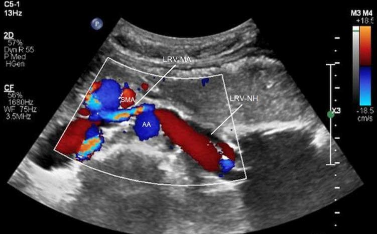 This color Doppler ultrasound image in the transverse plane demonstrates the anatomical relationship between the abdominal aorta (AA), superior mesenteric artery (SMA), and left renal vein (LRV), illustrating Nutcracker syndrome (renal vein compression syndrome). The SMA is positioned anterior to the AA, creating an acute angle where the meso-aortic segment of the left renal vein (LRV-MA) is seen compressed between these two arterial structures. The color Doppler indicates flow direction relative to the transducer, with the color bar ranging from +18.5 cm/s (red, toward) to -18.5 cm/s (blue, away). The AA and SMA show blue signals, indicating flow away from the transducer. The hilar segment of the left renal vein (LRV-NH) is significantly dilated compared to the compressed LRV-MA segment, a hallmark diagnostic feature of anterior Nutcracker syndrome. The LRV-NH exhibits a predominantly red signal, indicating venous return toward the transducer before it enters the narrow meso-aortic space. This imaging is critical for assessing venous hypertension and potential collateral circulation in patients presenting with hematuria or pelvic pain.