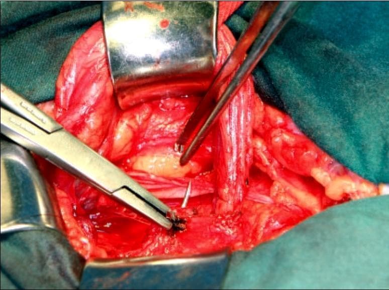 This clinical photograph captures an intraoperative view of an inguinal hernia repair, specifically demonstrating the second layer of a tissue-based reconstruction. The surgical field is exposed using metal retractors, revealing layered anatomical structures including the transversalis fascia and the inguinal ligament. A needle holder is seen in the foreground, manipulating a dark-colored suture to approximate the medial flap of the transversalis fascia to the shelving portion of the inguinal ligament. A second surgical instrument (tissue forceps) provides counter-traction to facilitate needle placement. The procedure illustrates an overlapping or imbrication technique, moving from the internal ring back toward the pubic tubercle to reinforce the posterior wall of the inguinal canal. The visual focus is on the meticulous placement of sutures to create a tension-free, multi-layered anatomical repair, emphasizing the relationship between the deep inguinal ring and the floor of the canal.