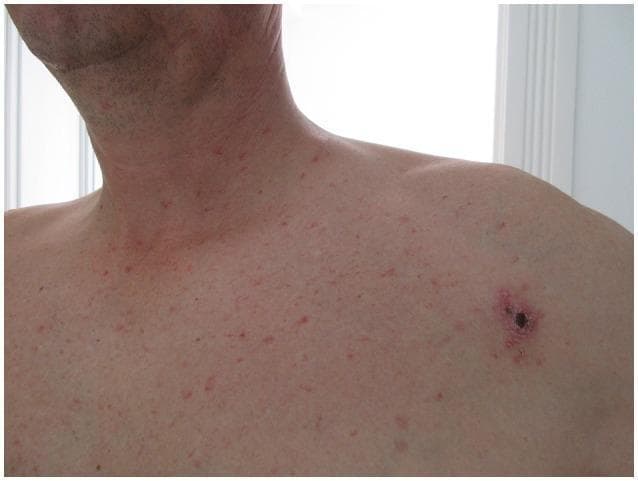 This clinical photograph displays two distinct dermatological manifestations on the upper torso and neck of an adult patient, captured on the 15th day of illness. Primary finding: A prominent 'tache noire' or inoculation eschar located in the left infraclavicular region. This lesion is characterized by a central, dark-black necrotic crust (eschar) surrounded by an erythematous halo indicating localized inflammation. Secondary finding: A generalized, non-pruritic, erythematous macular rash. The rash consists of diffuse, small, reddish macules approximately 2-5mm in diameter, distributed across the chest, shoulders, and lateral neck, creating a speckled appearance. These findings are clinically significant in the diagnosis of rickettsial diseases, such as Mediterranean Spotted Fever or scrub typhus, where an inoculation eschar serves as the primary portal of entry followed by a systemic maculopapular eruption. The image serves as an educational resource for identifying characteristic skin signs of zoonotic infectious diseases.