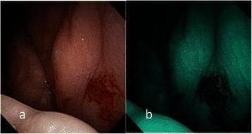 This composite diagnostic image displays an endoscopic examination of oral erythroplakia on the left buccal mucosa. Figure (a) utilizes conventional broadband white light (BWL), revealing a well-demarcated, flat, bright red plaque with a velvety and slightly glistening surface texture. Figure (b) shows the same lesion under Narrow-Band Imaging (NBI), which enhances the visualization of the microvascular architecture. The NBI view demonstrates Type IV intraepithelial papillary capillary loop (IPCL) destruction, characterized by irregular angiogenesis, loss of normal capillary loop structure, and a disorganized vascular arrangement. This microvascular pattern is a significant clinical indicator for advanced pathology. The clinical significance of this finding is demonstrated by the corresponding pathological diagnosis of invasive squamous cell carcinoma, highlighting the role of NBI in identifying high-risk premalignant and malignant lesions during oral cavity screening.