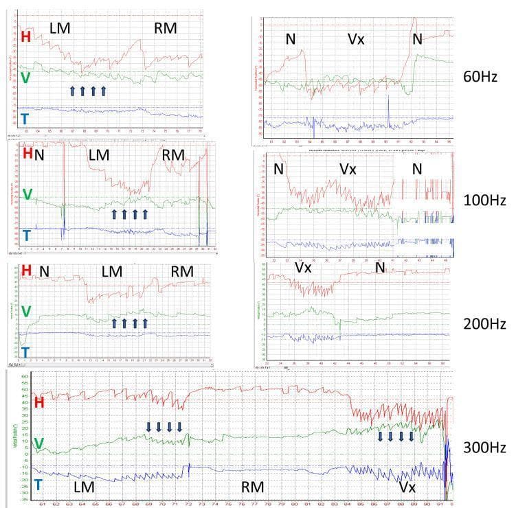 A compilation of three-dimensional videonystagmography (VNG) recordings illustrating stimulus-evoked vestibular-induced nystagmus (SVIN) in a patient with left superior semicircular canal dehiscence (uSCD). The panels display horizontal (H, red), vertical (V, green), and torsional (T, blue) ocular motor components across four bone conduction frequencies: 60 Hz, 100 Hz, 200 Hz, and 300 Hz. The recordings compare different stimulation sites including the left mastoid (LM), right mastoid (RM), vertex (Vx), and baseline no stimulation (N). Key findings demonstrate that the horizontal and torsional components remain consistently left-beating across all frequencies, particularly during vertex stimulation. In contrast, the vertical component exhibits frequency-dependent directionality: it is up-beating (indicated by upward arrows) at 60, 100, and 200 Hz, but reverses to a down-beating pattern (indicated by downward arrows) at 300 Hz. This clinical diagnostic image illustrates the use of high-frequency vibration to evaluate vestibular hypersensitivity and identify semicircular canal pathology.