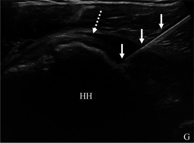 Diagnostic Image: Ultrasound (US) showing a glenohumeral joint corticosteroid injection via a posterior approach in a 46-year-old patient. The ultrasound frame displays a longitudinal view of the posterior shoulder anatomy including the humeral head (HH) and the glenoid (G). The bony surfaces appear as hypoechoic lines with deep acoustic shadowing. A more hyperechoic, fibrillar structure representing the infraspinatus tendon is indicated by a dashed arrow. An echogenic needle (solid arrows) is visualized in-plane using a medial-to-lateral trajectory. The needle tip is correctly positioned deep to the infraspinatus tendon, resting on the articular surface of the humeral head within the joint space. This clinical photograph demonstrates the real-time visualization required for accurate intra-articular needle placement to treat chronic shoulder pain or rotator cuff pathology while avoiding extra-articular injection.