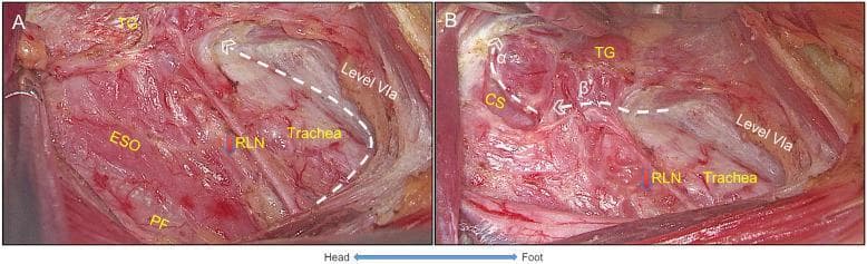 Two intraoperative clinical photographs (A and B) demonstrate the surgical dissection and settlement of the recurrent laryngeal nerve (RLN) during a thyroid procedure. Image A shows the anatomical relationship between the esophagus (ESO), trachea, and RLN within the expanded pretracheal space (Level VIa). The RLN is visualized running vertically in the tracheoesophageal groove, with the prevertebral fascia (PF) located posteriorly. Image B illustrates the completion of the RLN settlement. It features white dashed lines (α and β) marking critical surgical landmarks: Line α indicates the ligation of superior thyroid vessels with exposure of the cricothyroid space (CS) and preservation of the superior parathyroid gland, while Line β shows the resection plane where the thyroid gland (TG) was separated to expose the RLN's laryngeal entry point. The images highlight the surgical planes required for safe central neck dissection and preservation of neurovascular structures during endocrine surgery.