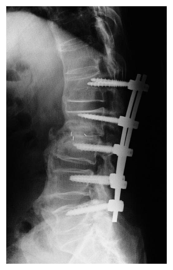 This lateral plain X-ray of the thoracolumbar spine demonstrates posterior spinal instrumentation and signs of Diffuse Idiopathic Skeletal Hyperostosis (DISH). The instrumentation consists of five pedicle screws connected by a vertical stabilizing rod. A critical finding is the significant 'back-out' and loosening of the most superior pedicle screw (at the L1 level), where the screw head is displaced posteriorly from the vertebral body compared to the other flush-mounted screws. The underlying anatomy shows characteristic 'flowing' anterior ossification of the vertebral bodies, consistent with DISH. There is noticeable narrowing and destructive change at the L2-L3 intervertebral disc space, suggesting pseudoarthrosis or instability. Small radiopaque markers are visible within the L2-L3 disc space, likely from a previous interbody fusion procedure. This diagnostic image illustrates a mechanical complication of spinal fusion in a patient with ankylosing spinal pathology, highlighting the risks of instrumentation failure and screw migration.