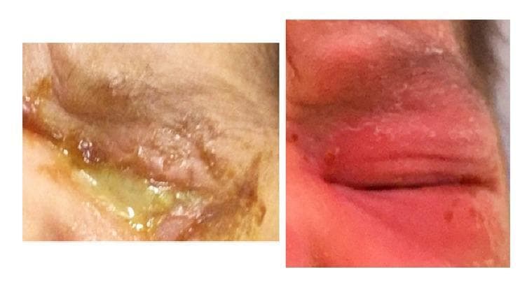 This clinical photograph set provides a side-by-side comparison of a neonatal eye before and after treatment for hyperacute bacterial conjunctivitis. The left panel shows the eye at presentation, characterized by severe blepharitis with marked eyelid edema and erythema. A profuse, thick, yellowish-green purulent discharge is seen emanating from the palpebral fissure, with associated crusting and maceration of the periocular skin. This presentation is classically associated with Neisseria species infection. The right panel demonstrates the clinical resolution following seven days of intravenous ceftriaxone therapy. There is a significant reduction in periorbital swelling and erythema, the complete absence of purulent exudate, and restoration of normal skin texture. The comparison illustrates the rapid clinical response of ophthalmia neonatorum to appropriate systemic antimicrobial therapy, emphasizing the importance of recognizing purulent neonatal conjunctivitis as a medical emergency.