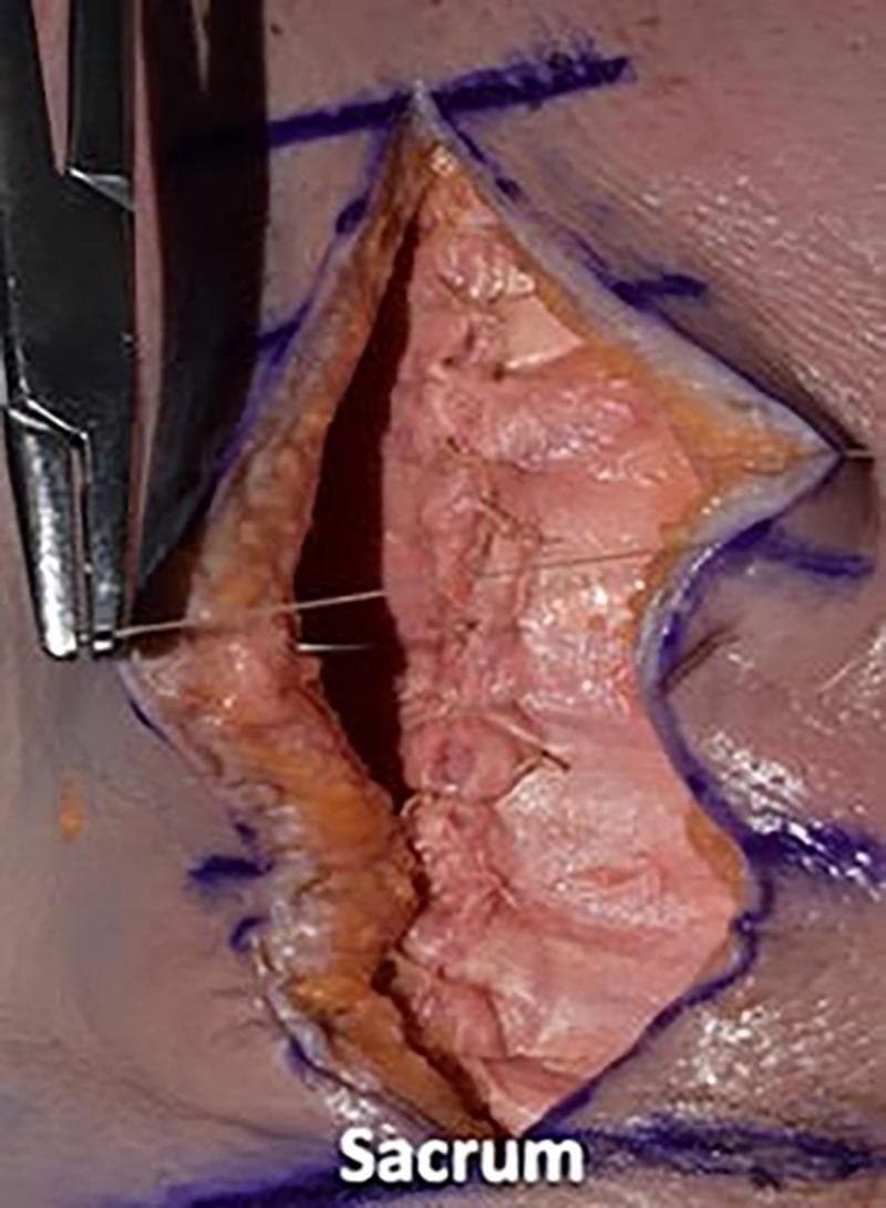 A clinical photograph demonstrating an intermediate stage of surgical wound closure in the lumbar region of a cadaveric specimen. The image shows a deep, longitudinal midline incision near the sacrum, with skin and subcutaneous fat layers retracted. The underlying deep fascial layer has been reapproximated using simple interrupted sutures, while the current step focuses on dermal closure. Specifically, 2-0 Vicryl sutures are being placed in an inverted, interrupted pattern to create buried knots, facilitating the reapproximation of the dermal edges without piercing the epidermal surface. Blue preoperative surgical markings are visible on the surrounding skin to guide the incision and alignment. A needle driver is shown on the left side of the frame, actively manipulating the suture material. This visual illustrates surgical techniques for layered wound closure, emphasizing deep-to-superficial tissue management and the use of absorbable sutures for dermal layers.