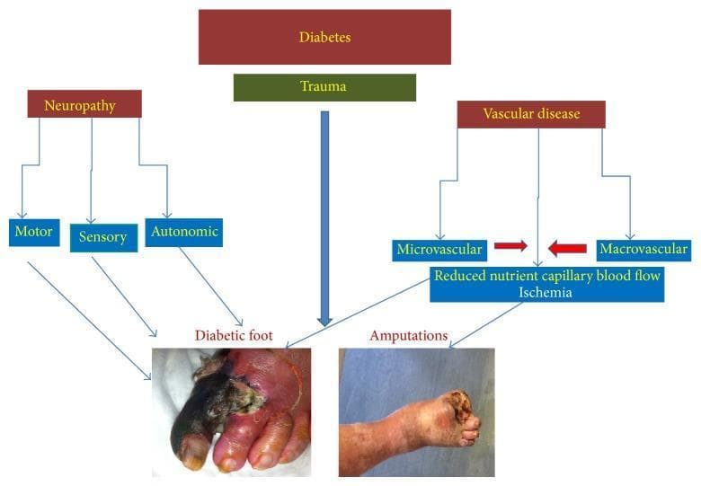 This pathophysiology flowchart illustrates the multifactorial pathogenetic pathways of Diabetic Foot Syndrome (DFS). The diagram is organized hierarchically, starting with 'Diabetes' as the primary systemic condition. It branches into two main complications: 'Neuropathy' (further sub-divided into motor, sensory, and autonomic components) and 'Vascular disease' (comprising microvascular and macrovascular pathology). These pathways converge through mediators like trauma and ischemia (reduced nutrient capillary blood flow) to clinical outcomes. The bottom of the chart features two clinical photographs: the left image labeled 'Diabetic foot' shows severe wet gangrene of the hallux and second digit, characterized by black necrotic tissue, purulent exudate, and surrounding erythematous inflammation. The right image labeled 'Amputations' demonstrates a post-operative status following a partial metatarsal or transmetatarsal amputation, showing a truncated distal foot with granulated tissue at the surgical site. This visual aid is designed for medical education regarding the complex interplay of ischemia and neuropathy in diabetic wound progression and limb loss.