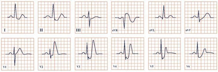 This diagnostic image displays a 12-lead electrocardiogram (ECG) snippet illustrating de Winter syndrome, a critical sign of acute proximal left anterior descending (LAD) artery occlusion. The precordial leads (V1–V6) demonstrate characteristic upsloping ST-segment depression at the J-point, transitioning into tall, prominent, and symmetrical 'hyperacute' T waves. This pattern is most pronounced in leads V2 through V4. Additionally, lead aVR exhibits a mild ST-segment elevation, which is a key diagnostic feature of this syndrome. The limb leads (I, II, III, aVL, aVF) show varied QRS morphologies, with predominantly positive deflections in I, II, aVL, and aVF, and a negative deflection in aVR. This ECG pattern is clinically significant as an ST-elevation myocardial infarction (STEMI) equivalent, indicating total or subtotal coronary occlusion despite the absence of classic ST-segment elevation in the precordial leads. The image serves as an educational tool for recognizing atypical ischemia patterns in emergency cardiology.