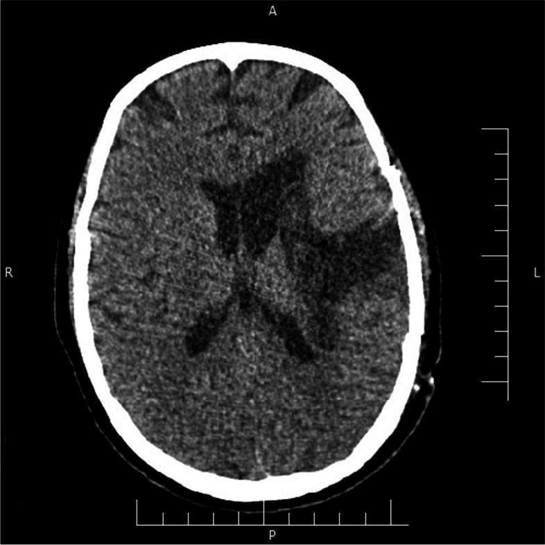 This diagnostic image is an axial non-contrast computed tomography (CT) scan of the brain, specifically a post-operative follow-up following evacuation of a left-sided intracranial hemorrhage. The image shows the brain at the level of the lateral ventricles. There is evidence of a left-sided craniotomy. In the left frontoparietal region and basal ganglia, there is a large area of hypoattenuation (low density), which represents encephalomalacia and evolving liquefactive necrosis in the site of the previous hematoma. The mass effect and midline shift observed in the acute phase have largely resolved, with the midline structures, including the septum pellucidum, returning to a near-normal position. The lateral ventricles appear symmetrical without evidence of acute intraventricular hemorrhage or hydrocephalus. No acute hyperdense areas suggestive of rebleeding are identified. This scan illustrates the expected radiological progression during the subacute phase of recovery following surgical hematoma evacuation in a patient with a history of COVID-19-associated neurological complications.